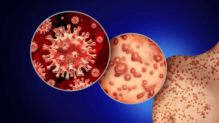 Viruela del mono: una emergencia de Salud celulas virus viruela del mono